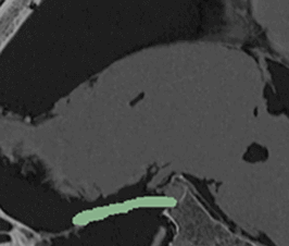 3d-printing-intraoperative-neuronavigation-tailoring-skull-base-reconstruction-after-extended-endoscopic-endonasal-surgery